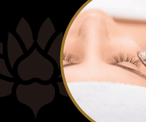 The Benefits Of Microdermabrasion